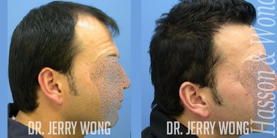 Hair Transplant before and after photo