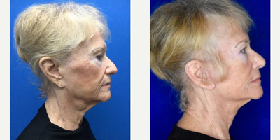 Lower Facelift before and after photo
