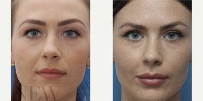 Revision Rhinoplasty before and after photo
