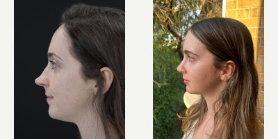 Revision Rhinoplasty before and after photo