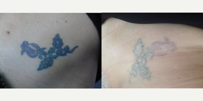 Tattoo Removal before and after photo