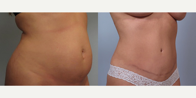 Tummy Tuck before and after photo