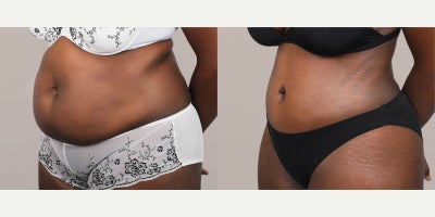 Tummy Tuck before and after photo