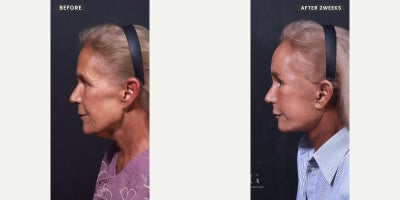 Facial Fat Transfer before and after photo