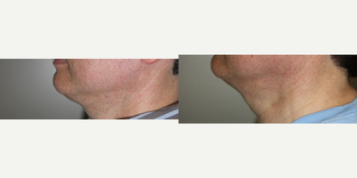 Kybella before and after photo