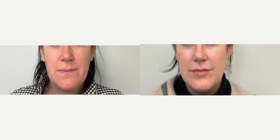 Lip Fillers before and after photo