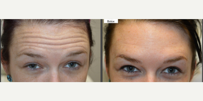 Botox before and after photo