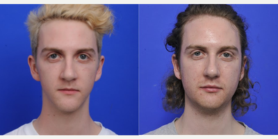 Chin Implant before and after photo