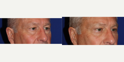 Eyelid Surgery before and after photo