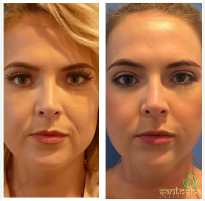 Restylane Defyne before and after photo