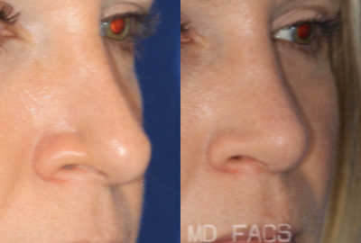 Revision Rhinoplasty before and after photo