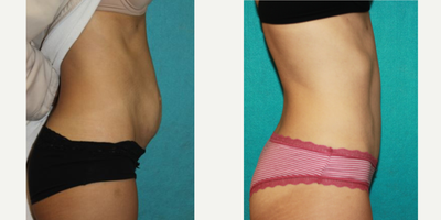 Tummy Tuck before and after photo