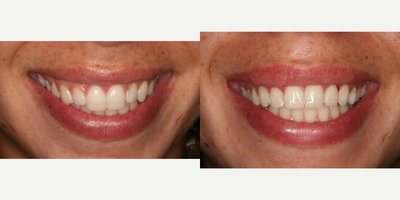 Dental Bonding before and after photo
