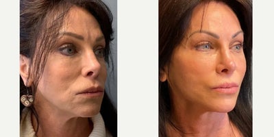 Neck Lift before and after photo