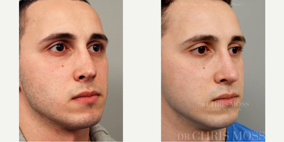 Revision Rhinoplasty before and after photo