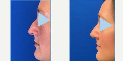 Rhinoplasty before and after photo