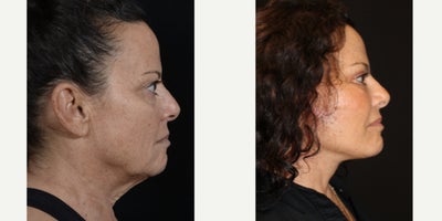 SMAS Facelift before and after photo