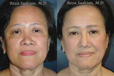 Asian Rhinoplasty before and after photo