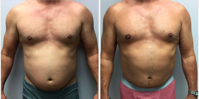 BodyTite before and after photo