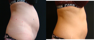 CoolSculpting before and after photo