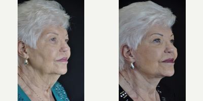 Facelift before and after photo