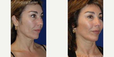 Neck Lift before and after photo