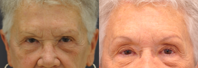 Brow Lift before and after photo