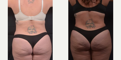Liposuction before and after photo