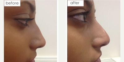 Nonsurgical Nose Job before and after photo