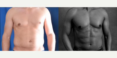 Vaser Liposuction before and after photo
