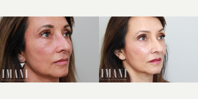 Botox before and after photo