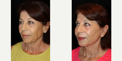 Double Eyelid Surgery before and after photo