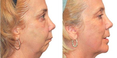 Facelift before and after photo