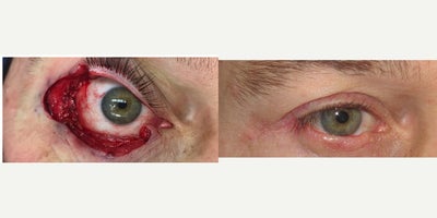 Facial Reconstructive Surgery before and after photo