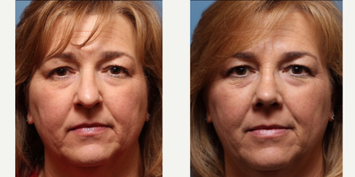 Rhinoplasty before and after photo