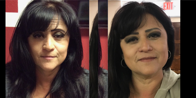 Skin Tightening before and after photo