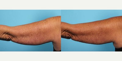 CoolSculpting before and after photo