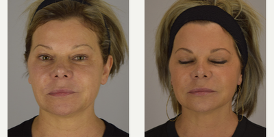 Facelift before and after photo
