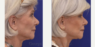 Neck Lift before and after photo