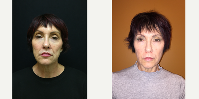 Bellafill before and after photo