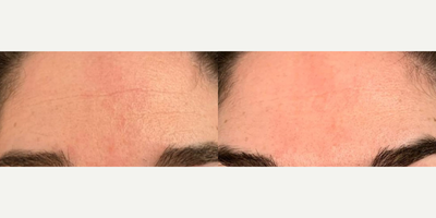 Botox before and after photo