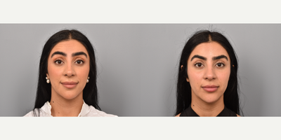 Botox before and after photo