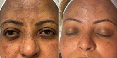 Fractional Laser before and after photo