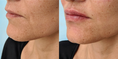 Juvederm before and after photo