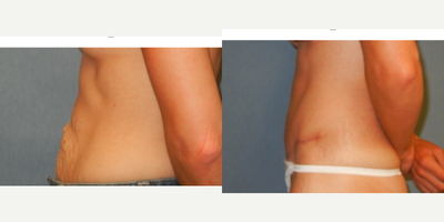 Tummy Tuck before and after photo