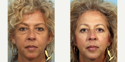 Eyelid Surgery before and after photo