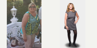 Gastric Sleeve Surgery before and after photo