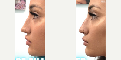 Nonsurgical Nose Job before and after photo