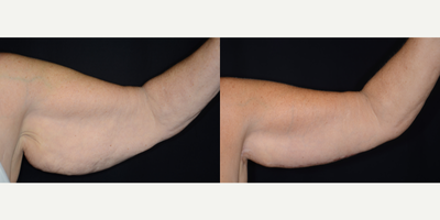 Arm Lift before and after photo