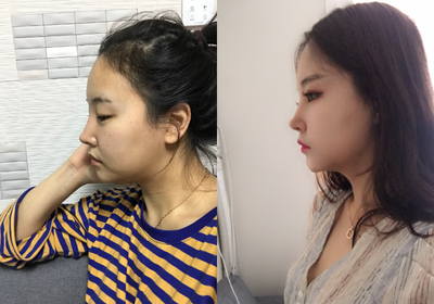 Chin Liposuction before and after photo